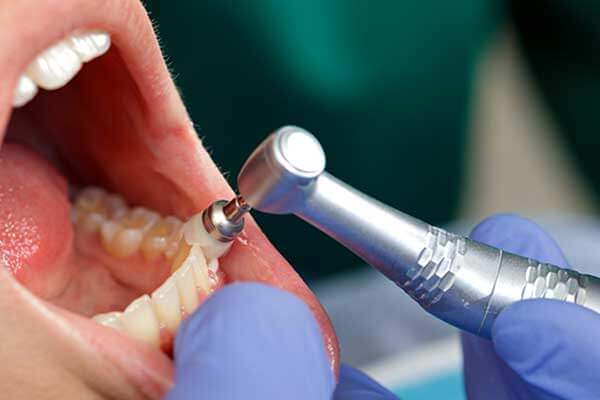 Tooth Cleaning Prophylaxis
