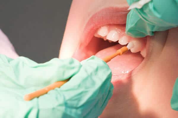 Fluoride treatment