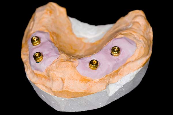 Full arch on 4 implants (1)