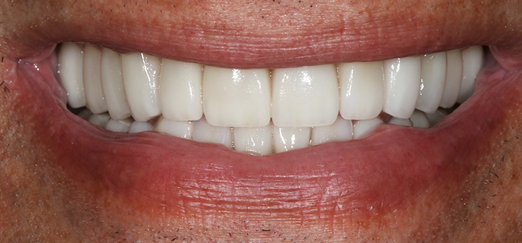 Full mouth rehab after photo4