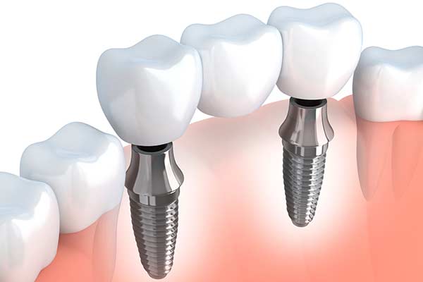 Implant Supported Bridges illustration