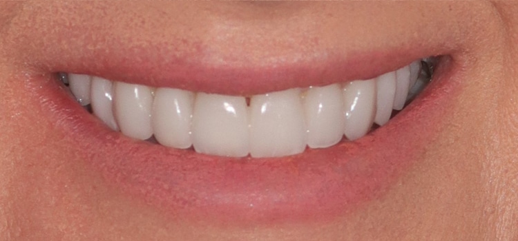 Porcelain veneers after photo12.copy